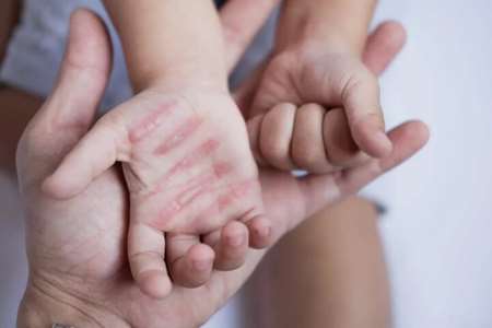 خنک‌سازی اولیه از پیشرفت سوختگی‌های سطحی جلوگیری می‌کند 