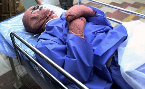  سوختگی در ایران هشت برابر میانگین جهانی است 