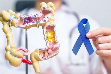  شناسایی به موقع ۹ مورد سرطان روده بزرگ در کاشان با غربالگری بیش از ۱۲ هزار نفر 